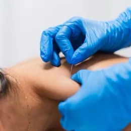 Séance d'acupuncture en cabinet de physiothérapie